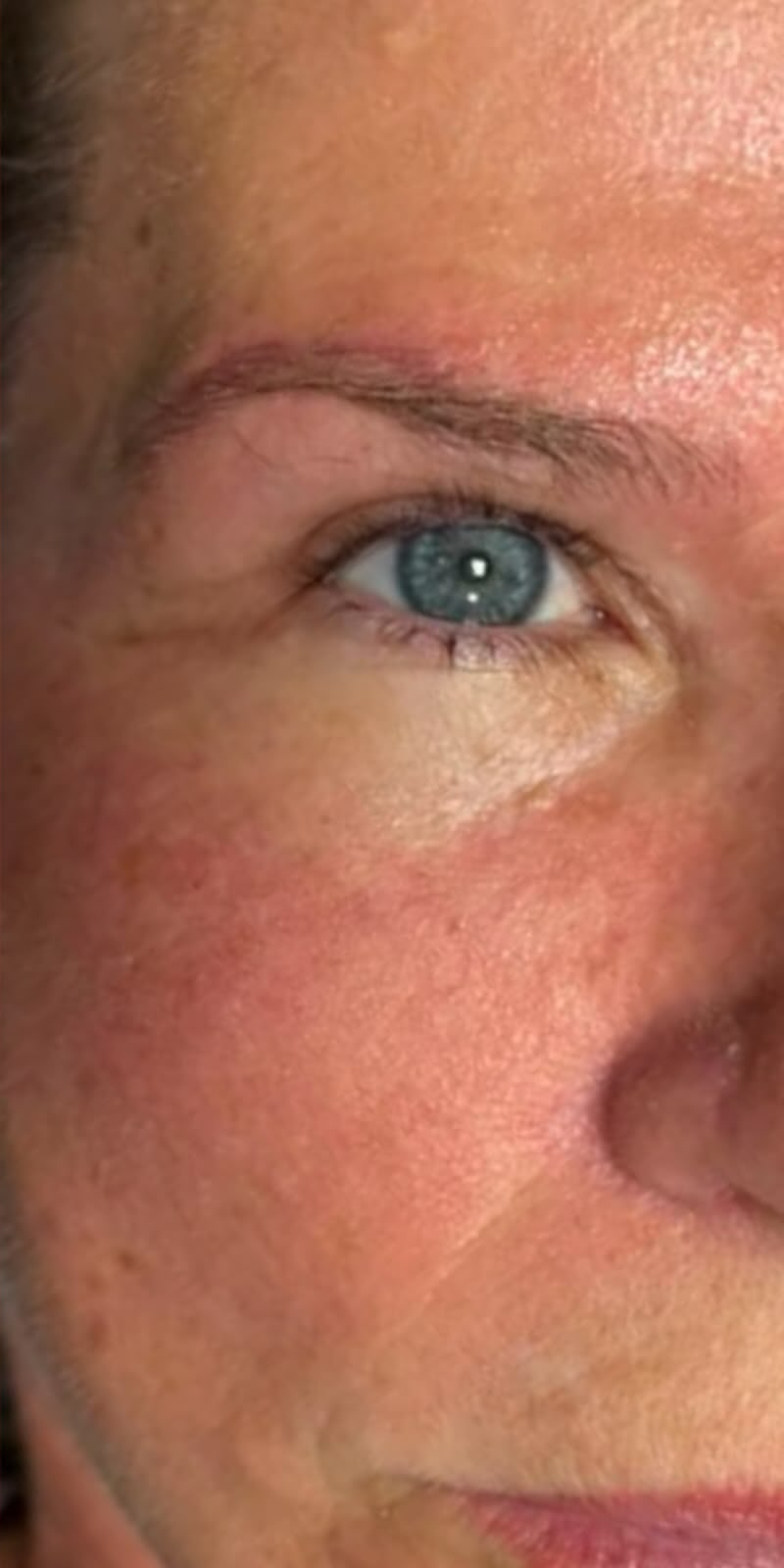 Olhar da paciente depois da blefaroplastia