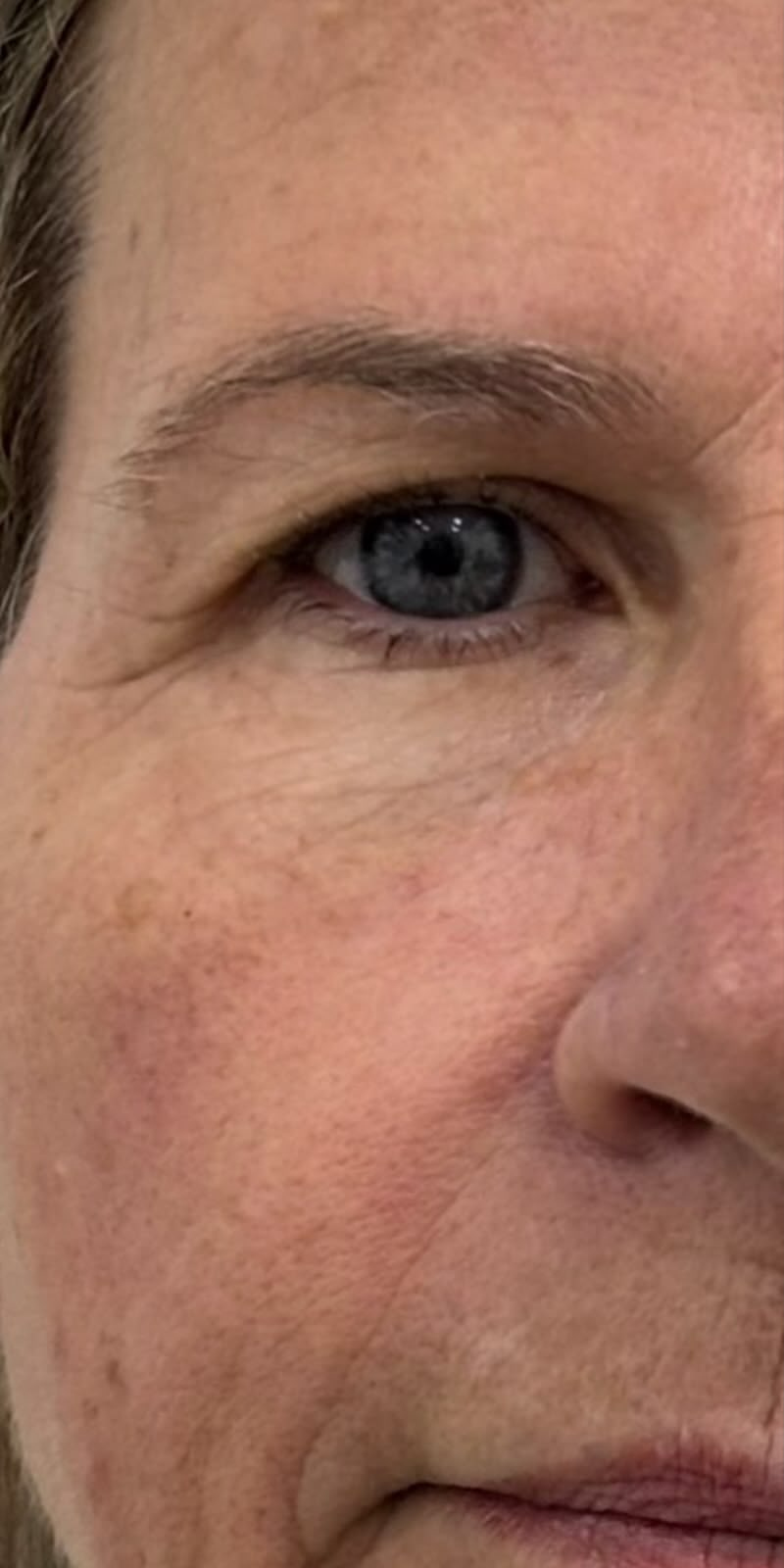 Pálpebra caída da paciente antes da blefaroplastia