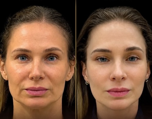 Caso Clínico 2 Antes e Depois