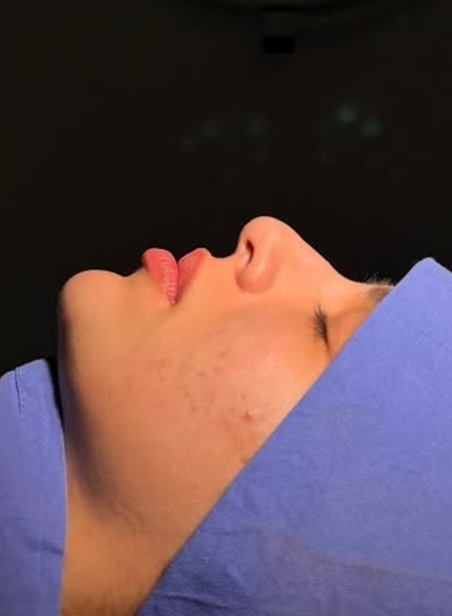 Perfil da paciente antes da rinoplastia