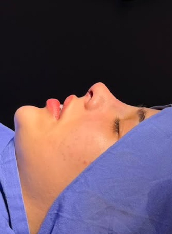 Perfil da paciente depois da rinoplastia